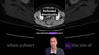 Abdominal CT Tutorials - Perforated diverticulitis