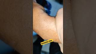 Cannulation karne ki full taiyari, how to insert cannula? #shorts #viral