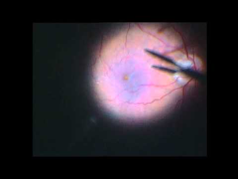 Cirugía ocular retina, vitrectomia mer ojo único membrana epirretiniana surgery