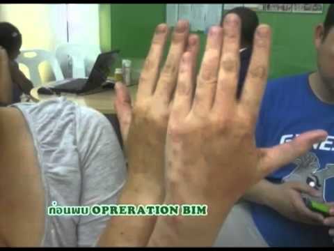 Befungin สำหรับโรคสะเก็ดเงิน Neurodermatitis โภชนาการเด็ก