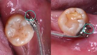 CC427. Clinical Tip: How to Secure the Wire End by Dr. Ashley Huang