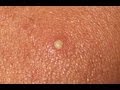 Funny -Kid Popping Pimples 