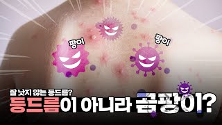왜 이렇게 안 없어지나 했더니, 곰팡이라고요?! - [언니네 피부과]