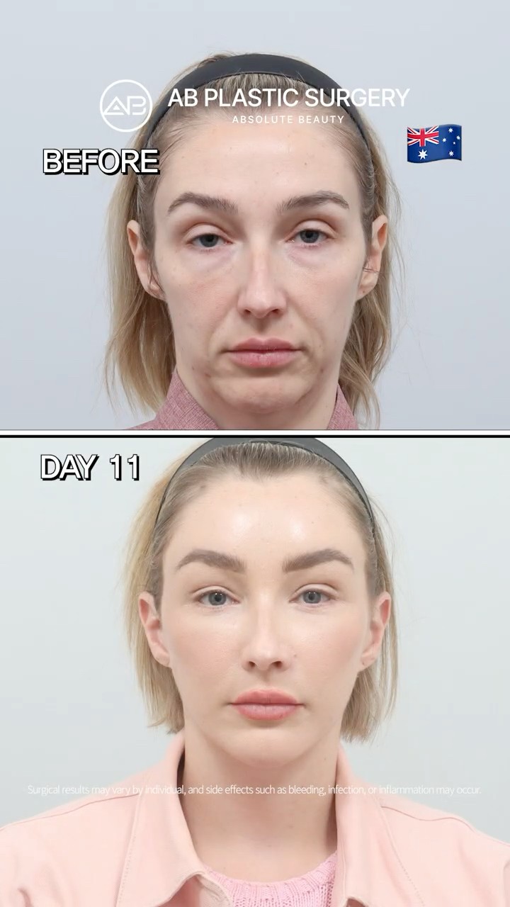 Full Face Lifting & Neck Lifting & Forehead Lifting