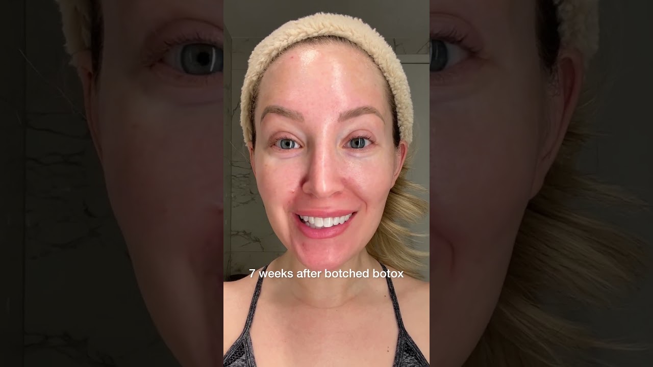 I Got Botched Botox | Before and After Bad Botox #shorts
