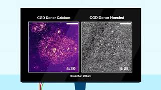 Chronic Granulomatous Disease Neutrophils Form Large Swarms at Random Locations