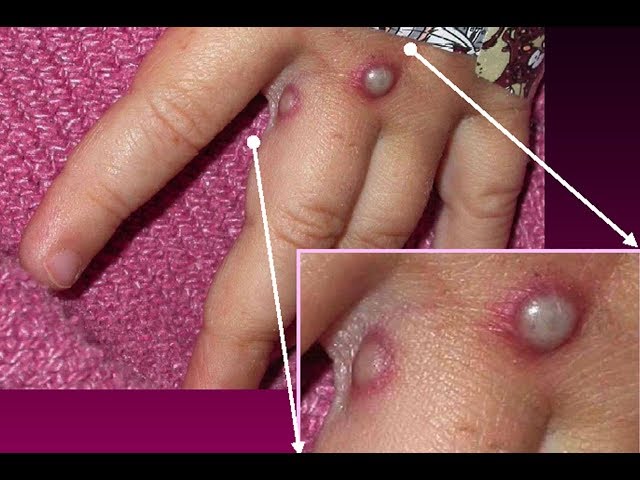 Vidéo Prononciation de Monkeypox en Anglais