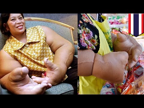 Endocrinologist Hindi ko na mawala ang timbang G namin pumayat