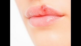 HOW TO GET RID OF AND PREVENT COLD SORES