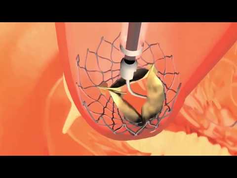 EVOLUT R MEDTRONIC QUALMED