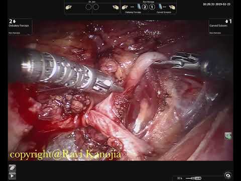Retroperitoneoskopowa pieloplastyka zwężenia połączenia miedniczkowo-moczowodowego z naczyniem krzyżującym z użyciem robota