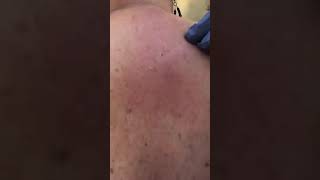 pimple extraction on back