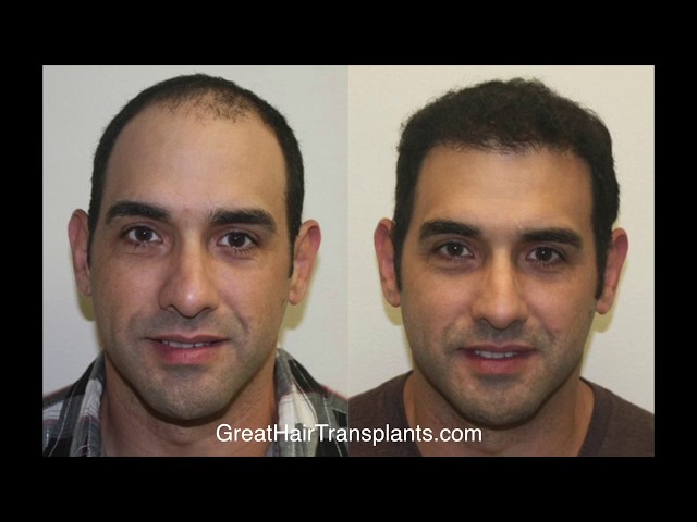 
Dr. Brett Bolton Patient Jesse FUE Correction

