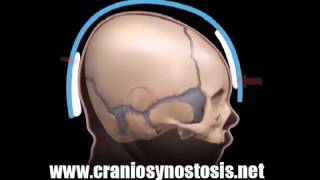Metopic Synostosis Helmet Therapy (Growth Lateral) - Craniosynostosis Surgery