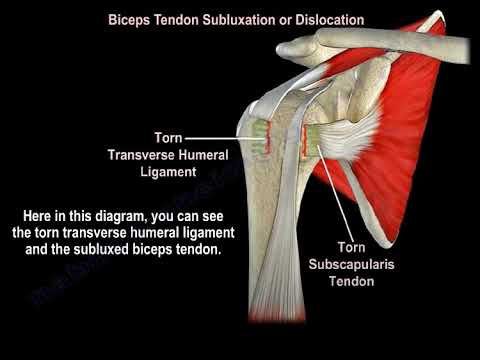 Biceps Tendon Subluxation Or Dislocation - Everything You Need To Know - Dr. Nabil Ebraheim