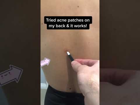 Back Acne? Try an Acne Patch! 💥 #skincare #acne #acnetreatment #pimples