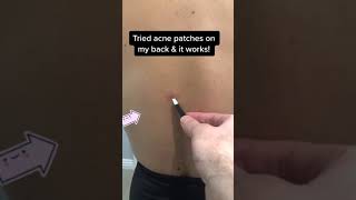 Back Acne? Try an Acne Patch! 💥 #skincare #acne #acnetreatment #pimples