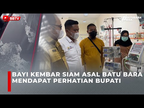 BAYI KEMBAR SIAM ASAL BATU BARA MENDAPAT PERHATIAN BUPATI