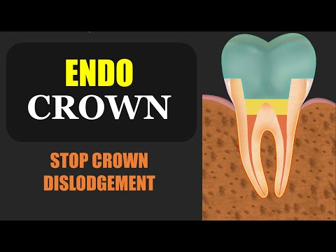 EndoCrown