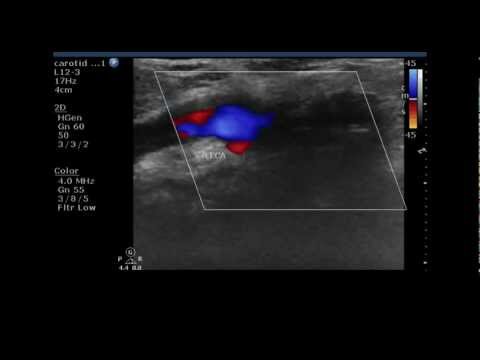 External Carotid Artery Stenosis Combined Color Doppler Ultrasound Video