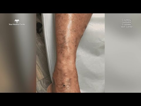 Your Healthy Family: Why you should care about your vein health