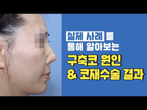 구축코현상 발생원인 및 구축코 변형의 종류와 코재수술결과를 사례로 알아보자!