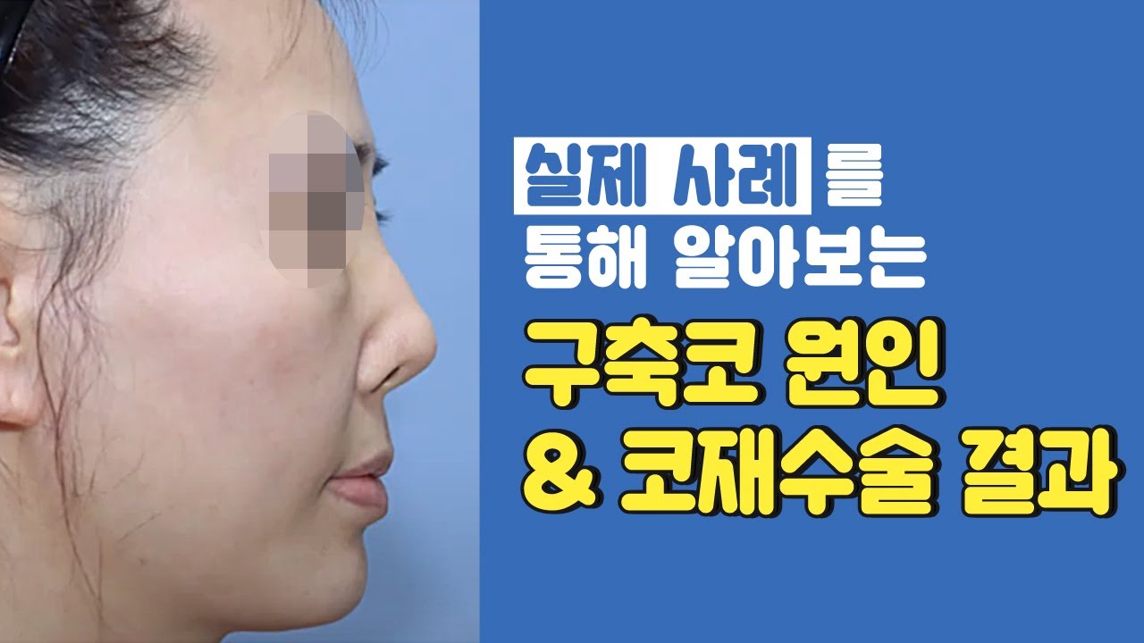 구축코현상 발생원인 및 구축코 변형의 종류와 코재수술결과를 사례로 알아보자!