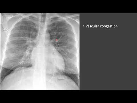 Pulmonary Edema
