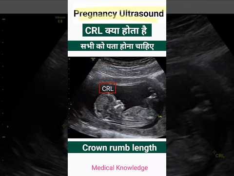 What is CRL in Pregnancy report - Learn to see Pregnancy ultrasound report #pregnancy