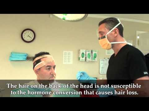 How Long Does a Hair Transplant Last? Video