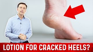 Why Lotion Never Fixes Cracked Heels and Dry Feet – Dr.Berg