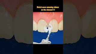 Download lagu incredible restoration of decayed front teeth!! mp3