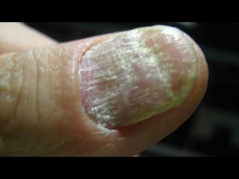 Die Behandlung gribka auf den Beinen bei den Schwangeren Wenn gribok der Nägel, den Nagel auszureißen