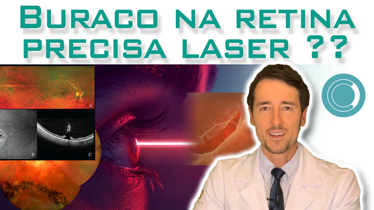 Buraco ou degeneração na retina sempre precisa laser?