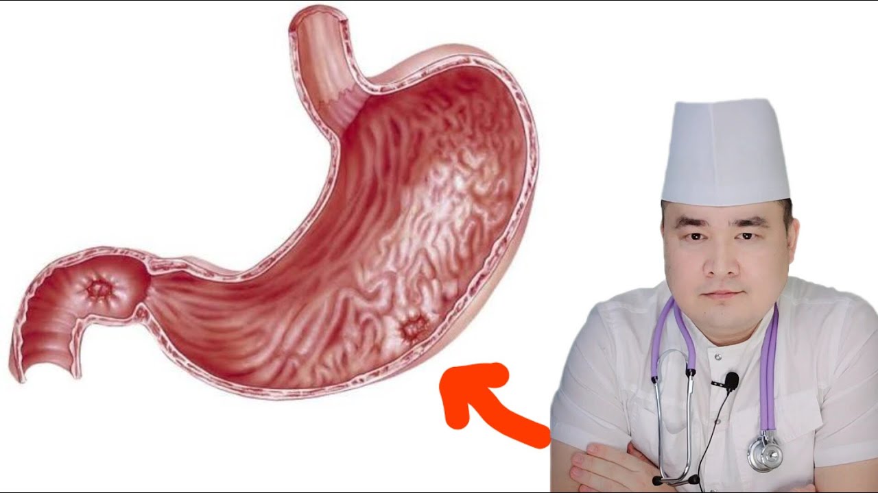 OSHQOZON YARASI VA DAVO CHORALARI