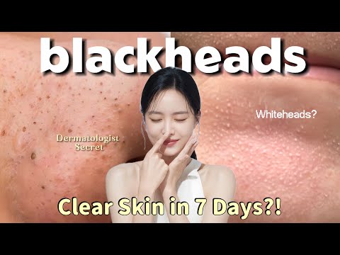 Blackheads & Whiteheads Removal Guide 🔥 | Dermatologist-Approved Tips for Clear Skin Naturally! 
