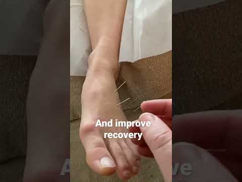 Acupuncture for ankle injury and recovery #acupuncture #treatment