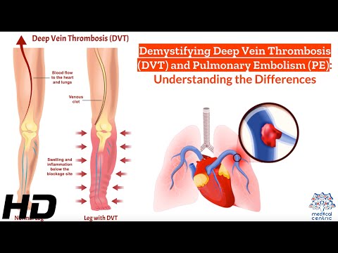 Brain Aneurysm Causes Signs and Symptoms Diagnosis and Treatment
