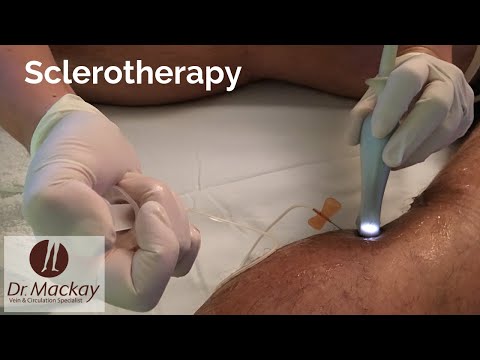 tratamentul picioarelor de sare varicoase tratamentul cu varicoza în zhytomyr