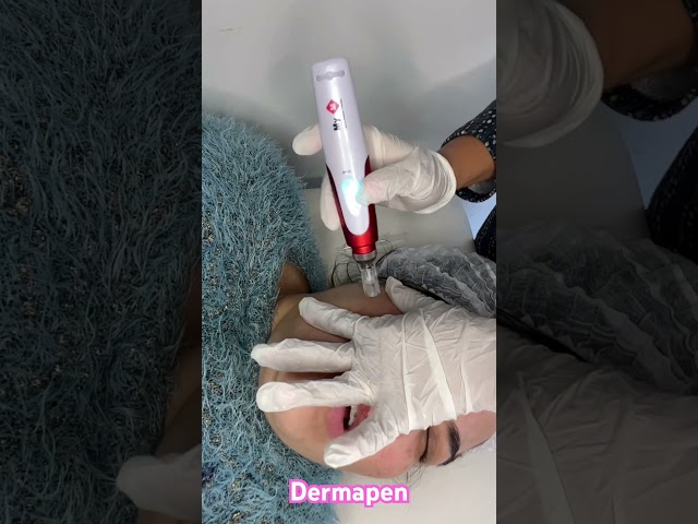Vídeo relacionado con Strata-triz Gel de secado rápido para tratamiento de cicatrices, 10g