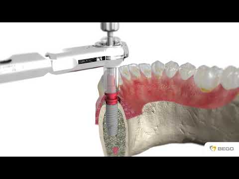 BEGO Semados® RS/RSXPro Implantate / RS RSX Pro Implants