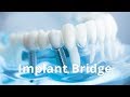 My Dental Implant Bridge Functions and Feels Perfect