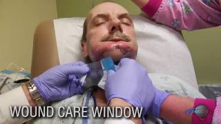 Wound Care Window- Oral Cutaneous Fistula