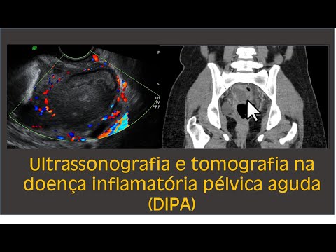 Ultrassonografia e tomografia na doença inflamatória pélvica aguda - DIPA