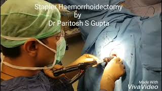 Piles treatment with Latest technique Stapler Haemorrhoidectomy