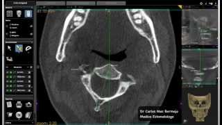 ESTUDIO 3D CRANEO-CERVICAL EN PACIENTE CON DOLOR MAXILAR Y MANDIBULAR IZQUIERDO