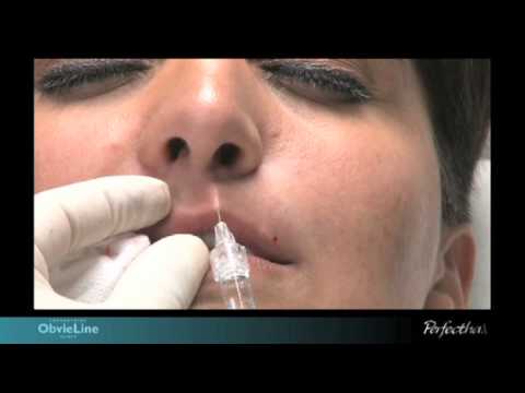 lip contour and volume augmentation with Perfectha Derm