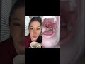 Dentist reacts to huge juicy tonsil stones #tonsilstones