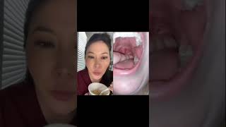 Download lagu Dentist reacts to huge juicy tonsil stones #tonsilstones mp3 Download lagu Dentist reacts to huge juicy tonsil stones #tonsilstones mp3