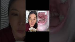 Dentist reacts to huge juicy tonsil stones #tonsilstones